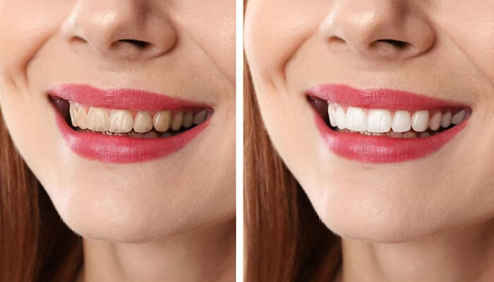 Transform Your Smile Safely: The Advantages of Professional Teeth Whitening Transform Your Smile Safely: The Advantages of Professional Teeth Whitening