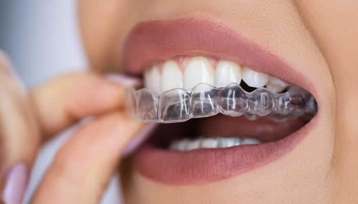 Understanding Your Options To Seamlessly Fix Misaligned Teeth Understanding Your Options To Seamlessly Fix Misaligned Teeth
