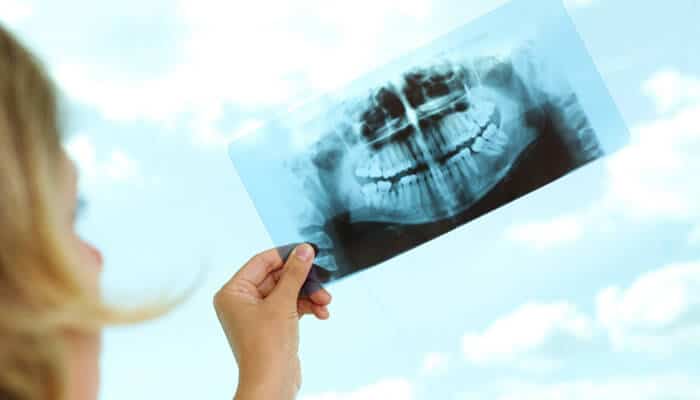 A dentist holding up a dental x-ray image against the sky, examining the patient’s teeth structure to plan treatments like dental implants and snoring guards for improved oral health.